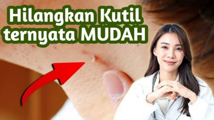 Muncul Kutil di Tubuh? Lakukan Cara Alami ini untuk Mengatasi Kutil Dengan Mudah, Cukup Gunakan Bahan Alami