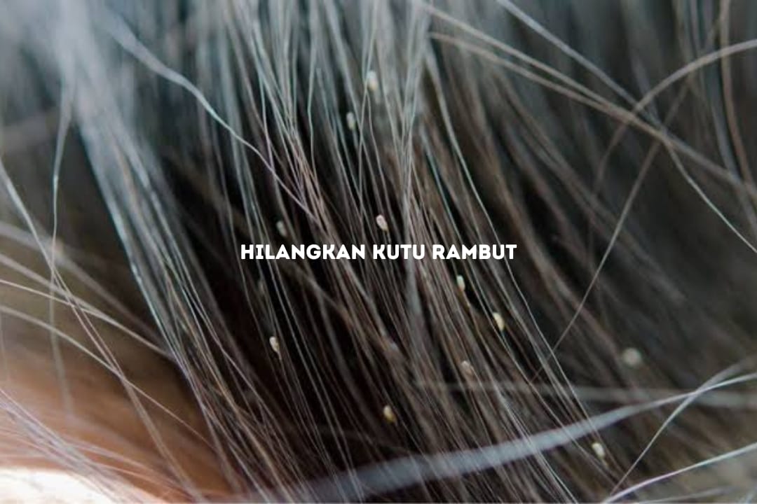 5 Cara Ampuh Hilangkan Kutu Rambut, Dijamin Kutu Langsung Musnah