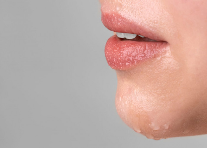 Khawatir Bibir Pecah Pecah Saat Puasa? Ini 5 Solusi Efektif Mengatasinya