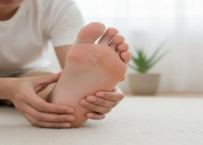 Telapak Kaki Gatal dan Mengelupas? Kenali 5 Penyebab dan Cara Mengatasinya